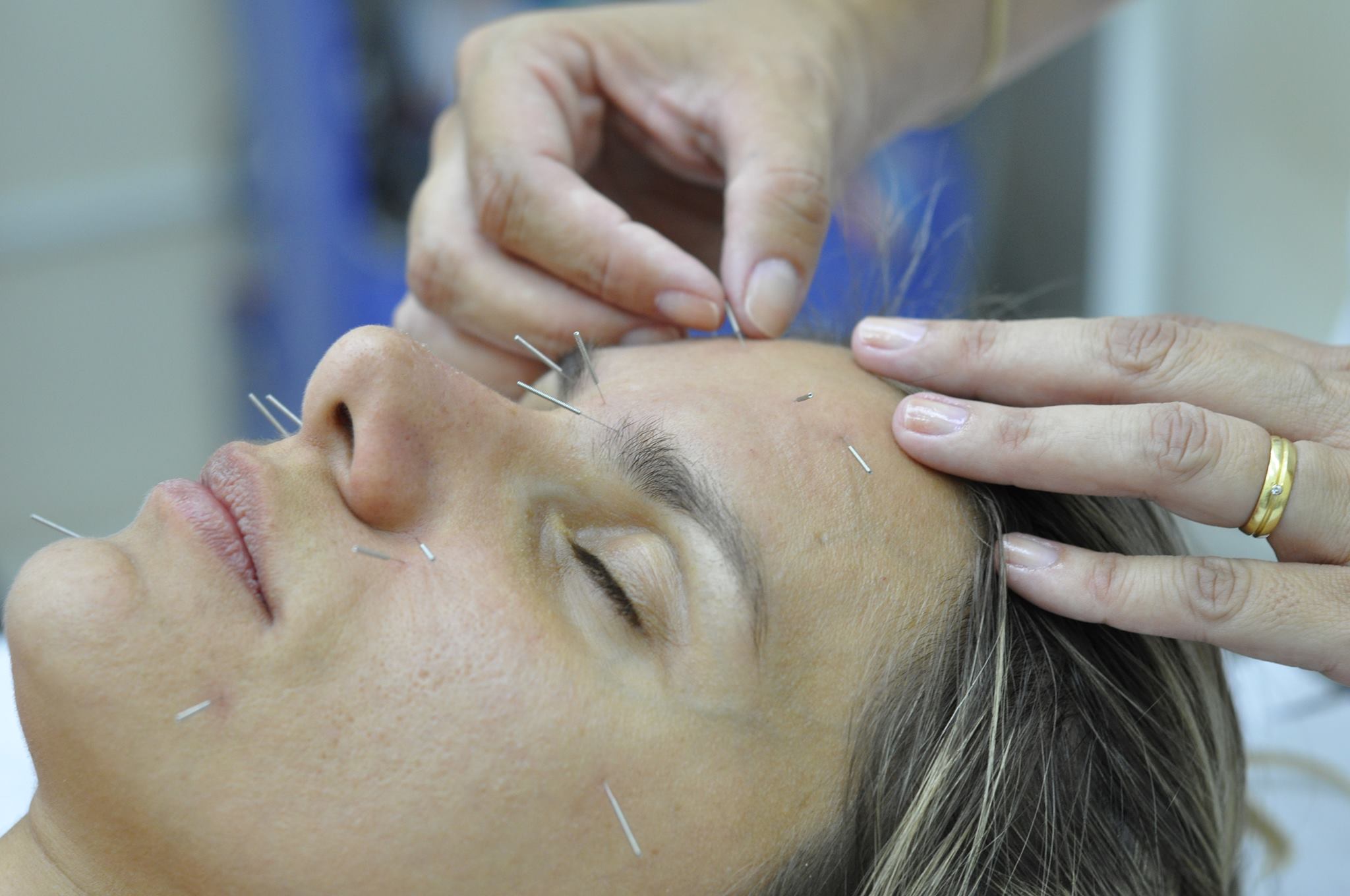 ACUPUNTURA | Clínica oferece tratamento estético com terapia milenar chinesa