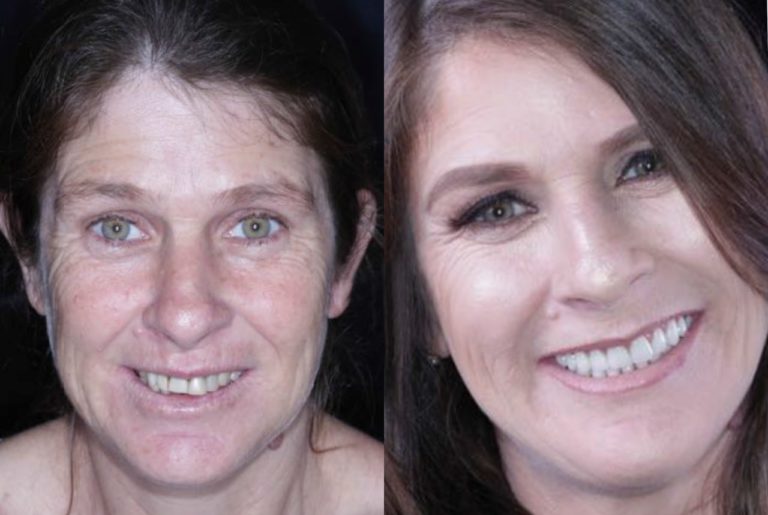 Conheça as desvantagens das dentaduras e veja como são os “implantes do futuro”